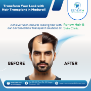 hair transplant clinic in madurai - Renew Hair and Skin Care Madurai