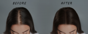 Scalp Tattoo Near Vancouver: Restoring Confidence with Natural-Looking Hairlines Vancouver