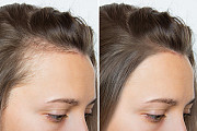 Womens Scalp Tattoo: Discreet, Long-Lasting Illusion for Feminine Hair Restoration Vancouver