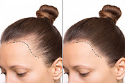 Womens Scalp Tattoo: Discreet, Long-Lasting Illusion for Feminine Hair Restoration Vancouver