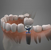 Best Dental Implant in Mumbai Mumbai