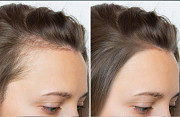 Hairline Tattoo: Restoring Confidence and Enhancing Looks Vancouver