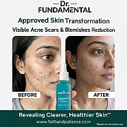 Clarifying Serum for Acne & Dark Spots: Clear Skin Routine That Works Jaipur