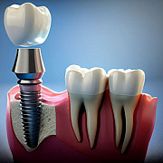 Dental Implants in Mumbai | Best Implant Dentist in Mumbai | Dr Teeth Mumbai
