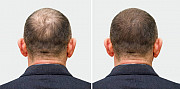 Hair Transplant in Riyadh from Riyadh