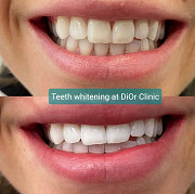 Get Your Brightest Smile with LED Teeth Whitening Treatment in Pascoe Vale Melbourne
