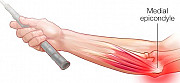 Treatment for tennis elbow/golfer elbow Lagos